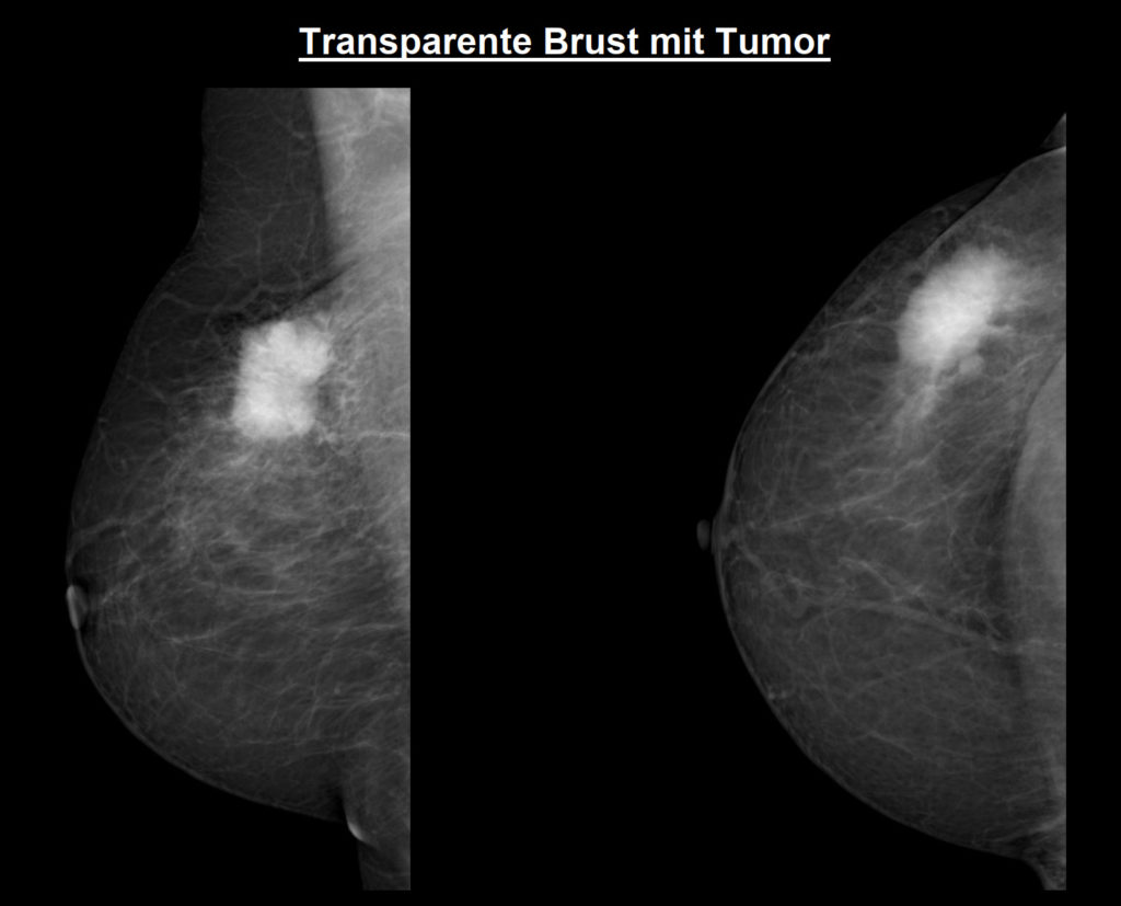 In dichtes der brust gewebe Dichtes Brustgewebe